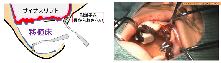 髙田先生は、上顎のサイナスリフトをおこないながらインプラントを10本入れる手術を、わずか1時間半ほどで終わらせます。「どうやったら、そんなに早くできるの？」と思われたのなら、このテクニックは見逃せません。