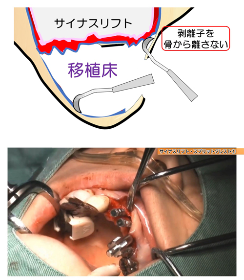 髙田先生は、上顎のサイナスリフトをおこないながらインプラントを10本入れる手術を、わずか1時間半ほどで終わらせます。「どうやったら、そんなに早くできるの？」と思われたのなら、このテクニックは見逃せません。