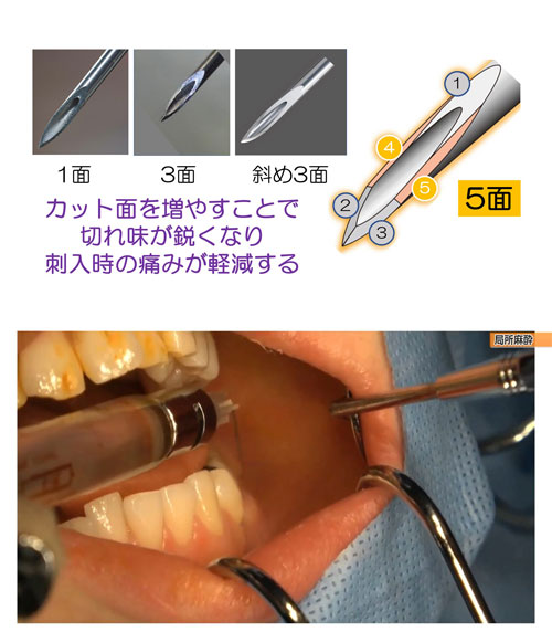 局所麻酔のチクッという痛みを嫌う患者さんはたくさんいます。髙田先生の刺入法なら、ほとんど痛みを感じさせずに局所麻酔ができます。これは、痛覚と触覚、圧覚の特性を利用したテクニックです。