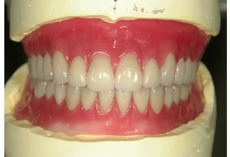 人工歯配列