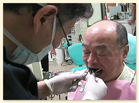 治療義歯の咬合調整