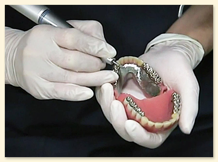 完成義歯のセットと調整
