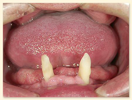 総義歯作製前の口腔内写真分析