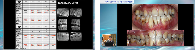 ６～７ミリの深いポケットも、外科的操作ナシで改善できる技術です