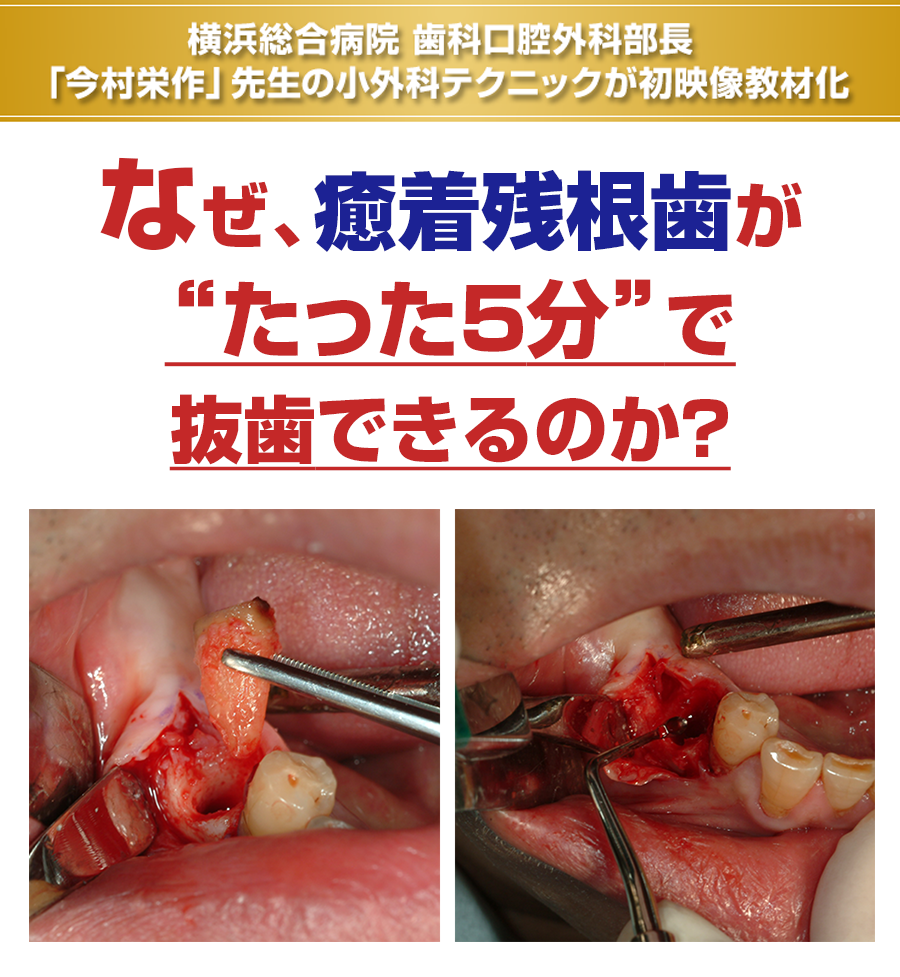 横浜総合病院 歯科口腔外科部長「今村栄作」先生の小外科テクニックが初映像教材化。なぜ、４根湾曲の上顎智歯でもわずか５分で破折なくスーッと抜歯できるのか？