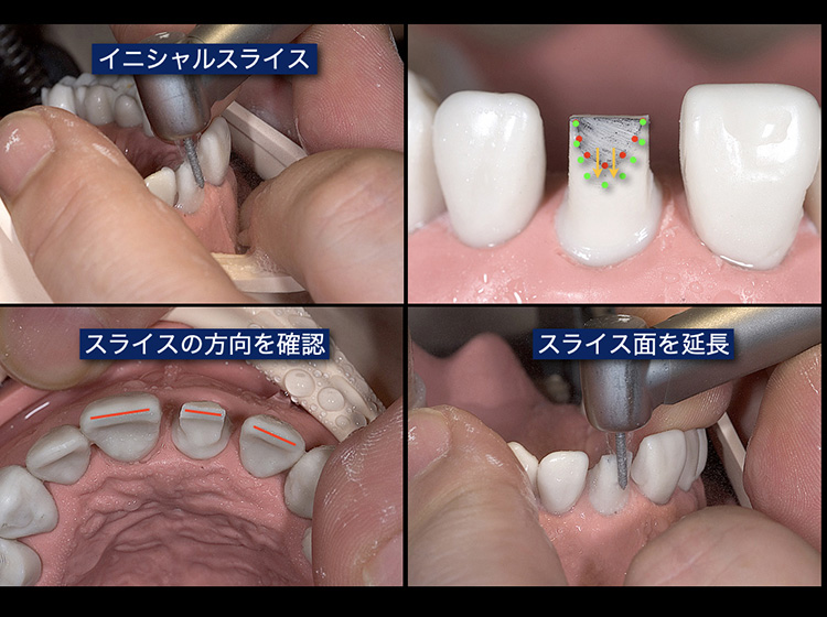 上達の近道は、前歯部の形成にあります