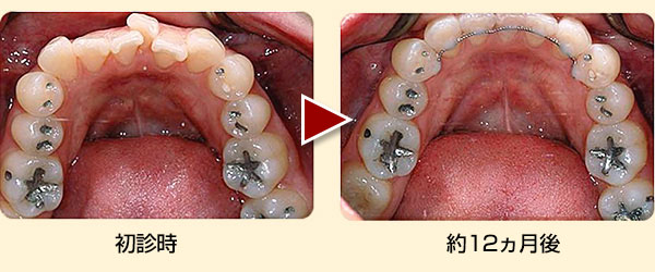 叢生（クラウディング）右側中切歯の抜歯症例