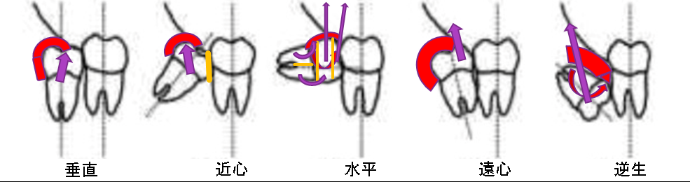 垂直、近心、水平、遠心、逆生で分類し各タイプで効果的な抜歯技術を開発