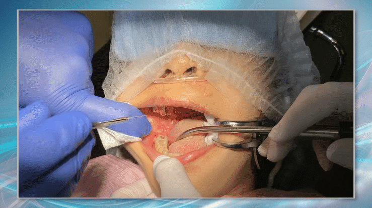 この方法なら、「総合的に低侵襲な抜歯」ができます