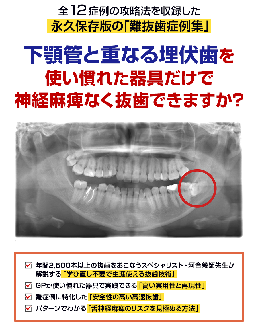 全12症例の攻略法を収録した永久保存版の「難抜歯症例集」下顎管と重なる埋伏歯を使い慣れた器具だけで神経麻痺なく抜歯できますか？