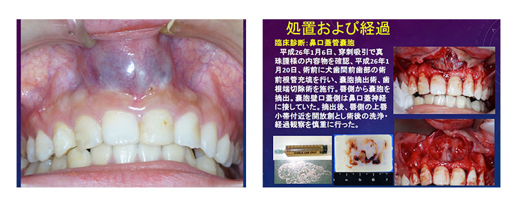 集合性歯牙腫
