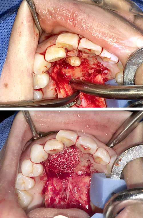 集合性歯牙腫