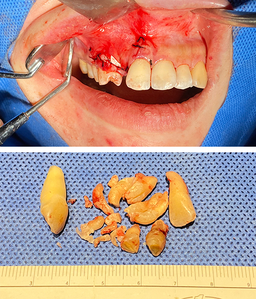 集合性歯牙腫のオペ動画