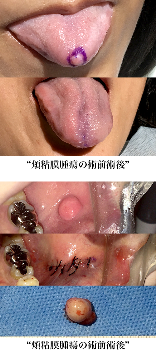 舌腫瘍の術前術後
