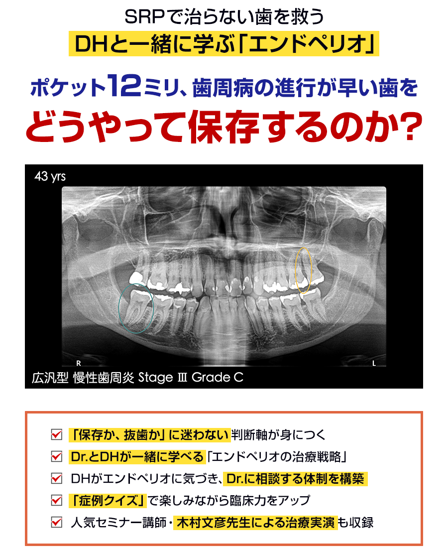 SRPで治らない歯を救うDHと一緒に学ぶ「エンドペリオ」ポケット12ミリ、歯周病の進行が早い歯をどうやって保存するのか？