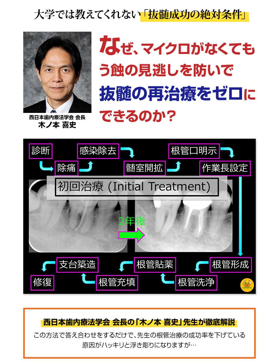 大学では教えてくれない「抜髄成功の絶対条件」なぜ、マイクロがなくてもう蝕の見逃しを防いで抜髄の再治療をゼロにできるのか？