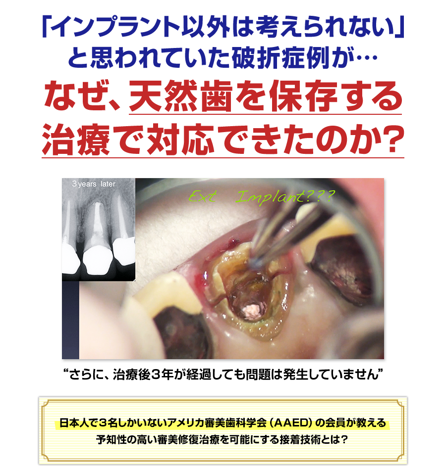 「インプラント以外は考えられない」と思われていた破折症例が…なぜ、天然歯を保存する治療で対応できたのか？日本人で３名しかいないアメリカ審美歯科学会（AAED）の会員が教える予知性の高い審美修復の治療を可能にする接着技術とは？