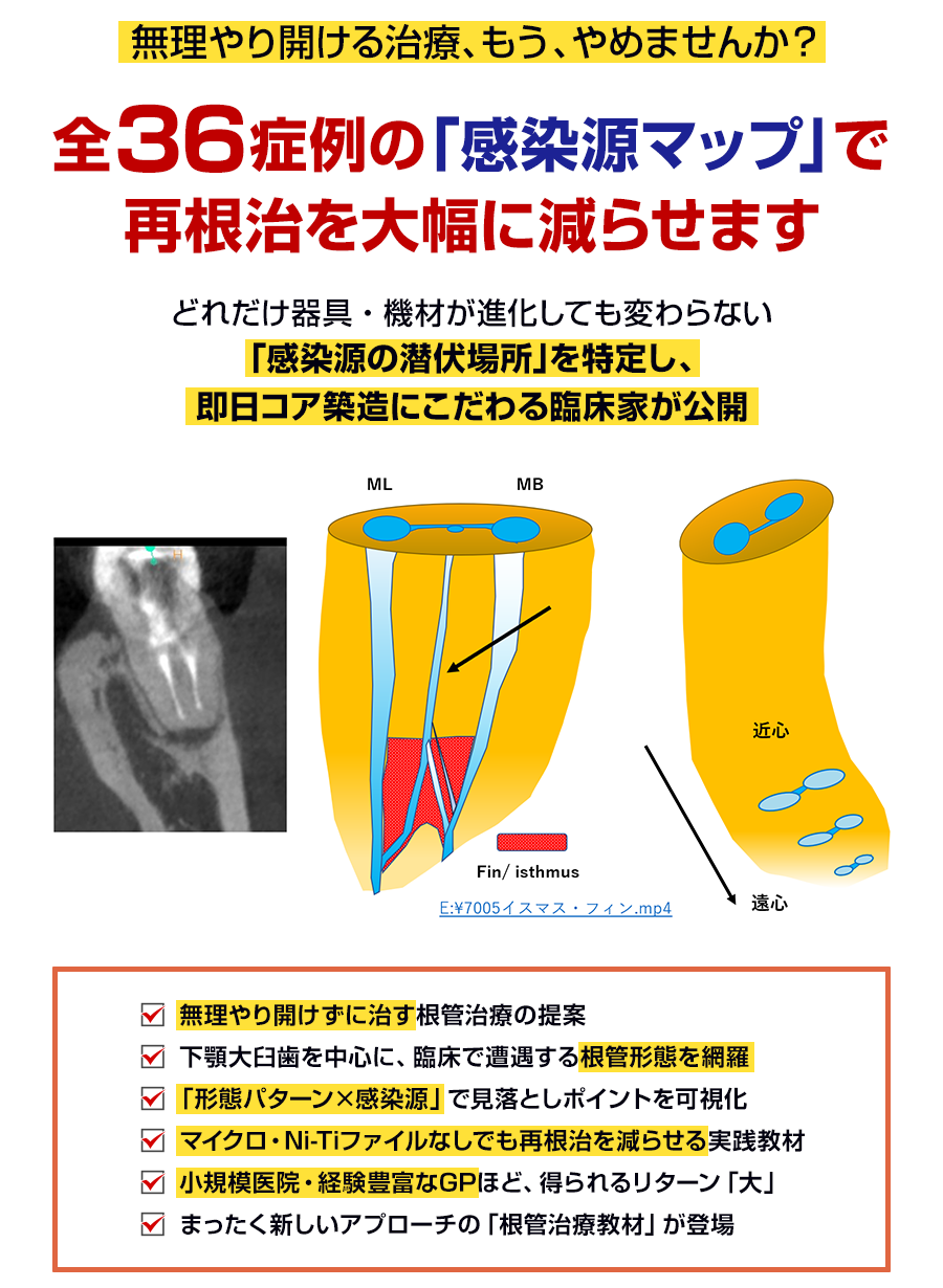 無理やり開ける治療、もう、やめませんか？全36症例の「感染源マップ」で再根治を大幅に減らせます