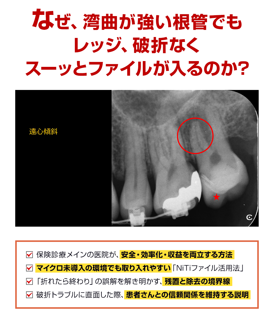 なぜ、湾曲が強い根管でもレッジ、破折なくスーッとファイルが入るのか？