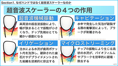 超音波スケーラーさえあれば、明日からすぐに実践できます