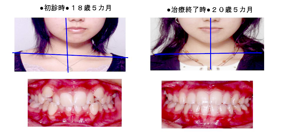 歯列だけではなく、頸部の傾きが劇的に改善した症例