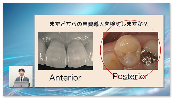 臼歯部から自費CR修復を導入すれば、審美面のハードルが低くなります