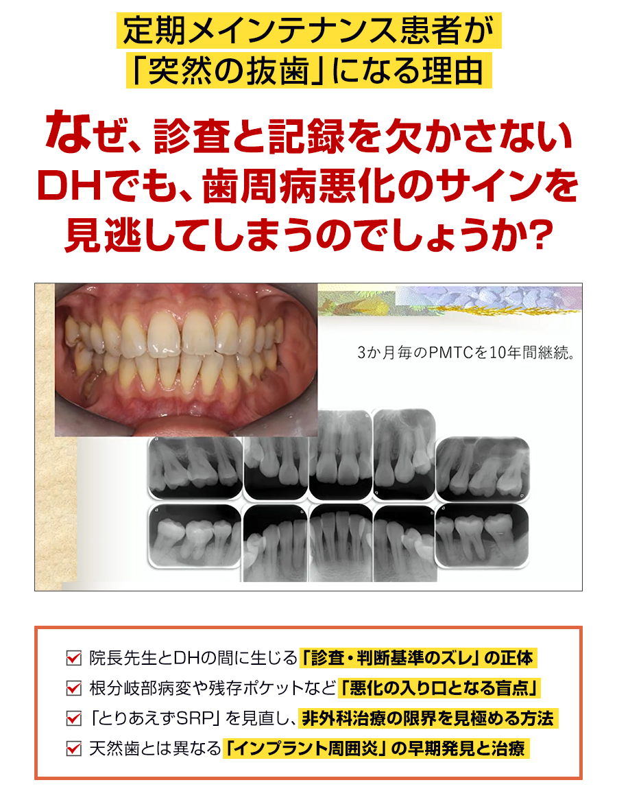 定期メインテナンス患者が「突然の抜歯」になる理由。なぜ、診査と記録を欠かさないDHでも、歯周病悪化のサインを見逃してしまうのでしょうか？
