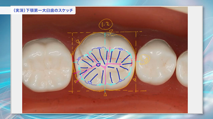 形成、充填、補綴と応用範囲の広いテクニックを学べます
