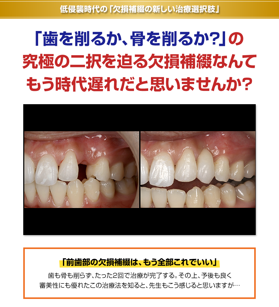 低侵襲時代の「欠損補綴の新しい治療選択肢」「歯を削るか、骨を削るか？」の究極の二択を迫る欠損補綴なんてもう時代遅れだと思いませんか？