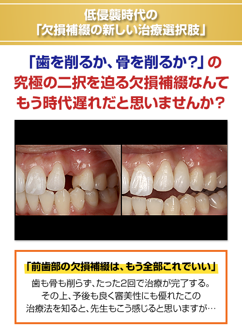 低侵襲時代の「欠損補綴の新しい治療選択肢」「歯を削るか、骨を削るか？」の究極の二択を迫る欠損補綴なんてもう時代遅れだと思いませんか？