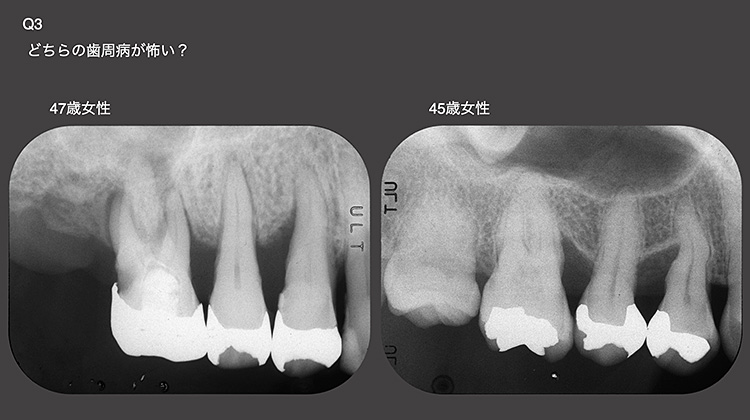 動画セミナー視聴後は、即座に「左が深刻だ」判断できるはずです