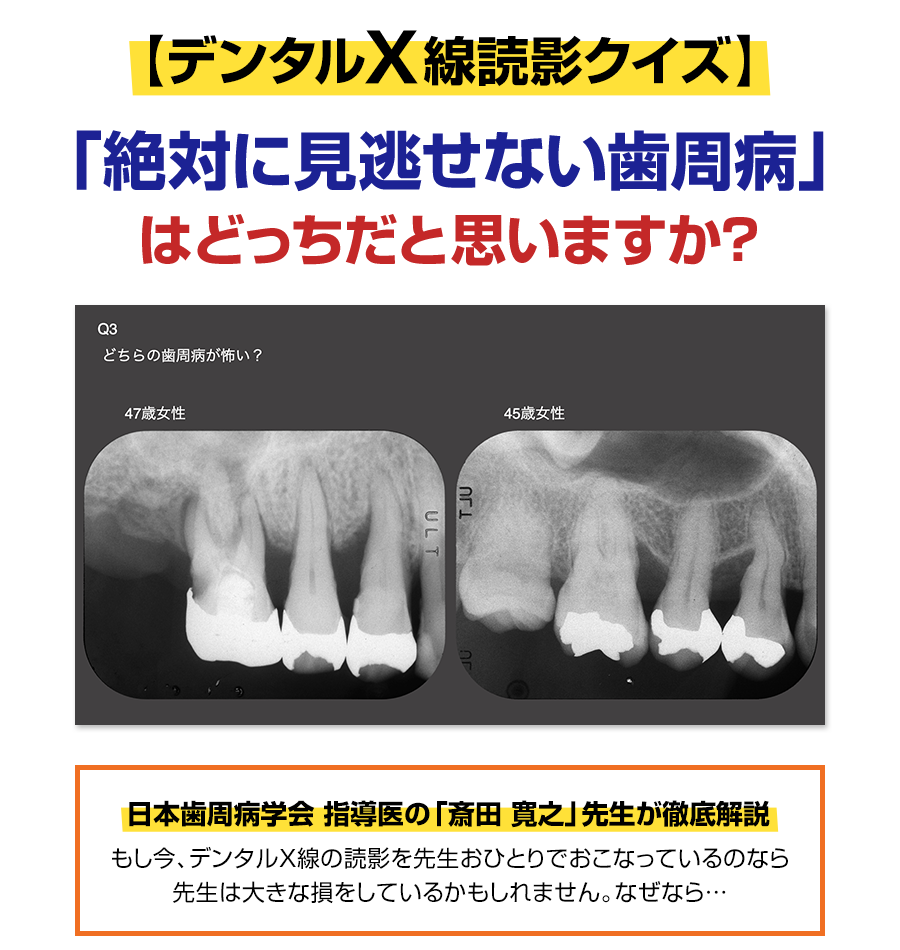 【デンタルX線読影クイズ】「絶対に見逃せない歯周病」はどっちだと思いますか？