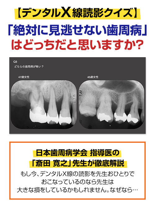 【デンタルX線読影クイズ】「絶対に見逃せない歯周病」はどっちだと思いますか？
