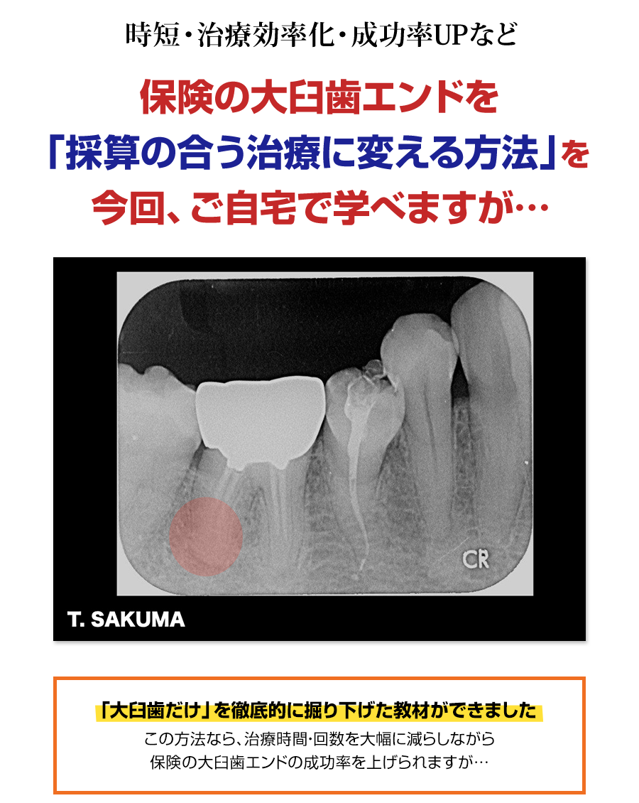 保険の根管治療を「採算の合う治療」に変えたい先生へ。なぜ、再治療をくり返してばかりの大臼歯の根管治療がたった２回で完了するのか？