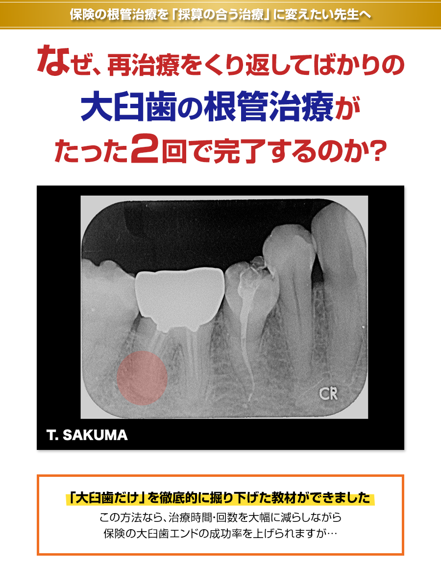 保険の根管治療を「採算の合う治療」に変えたい先生へ。なぜ、再治療をくり返してばかりの大臼歯の根管治療がたった２回で完了するのか？