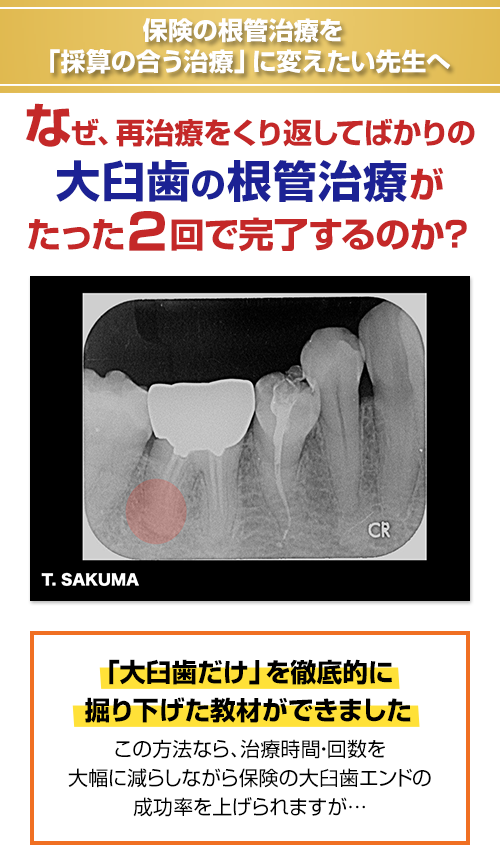 保険の根管治療を「採算の合う治療」に変えたい先生へ。なぜ、再治療をくり返してばかりの大臼歯の根管治療がたった２回で完了するのか？