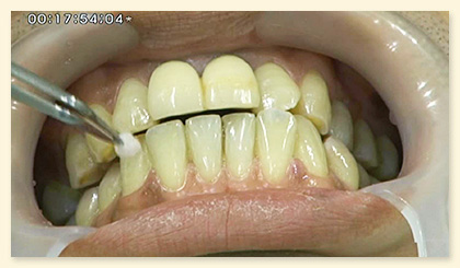 多くの歯科医師から注目されているホワイトニング技術