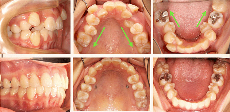 装置を使い、顎骨形態に沿った歯の移動をおこないます