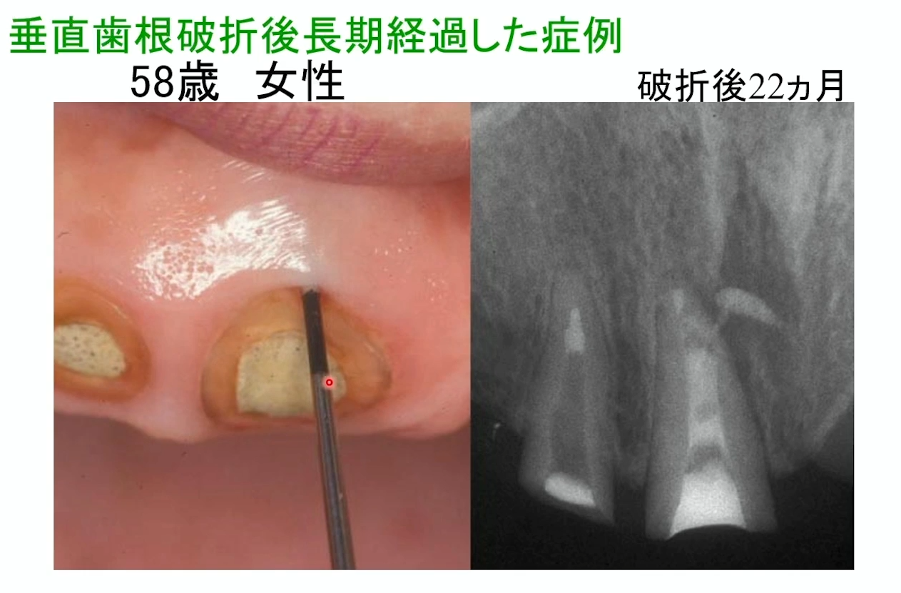 垂直歯根破折後、長期間経過した症例