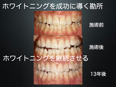 須崎先生による「ホワイトニングの実演」も収録しました