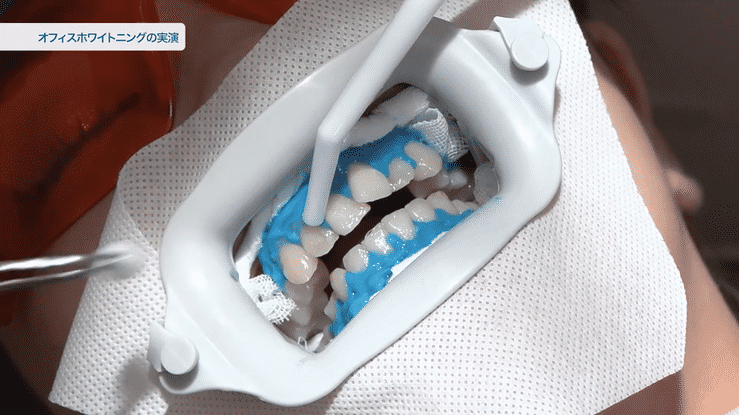 須崎先生による「ホワイトニングの実演」も収録しました