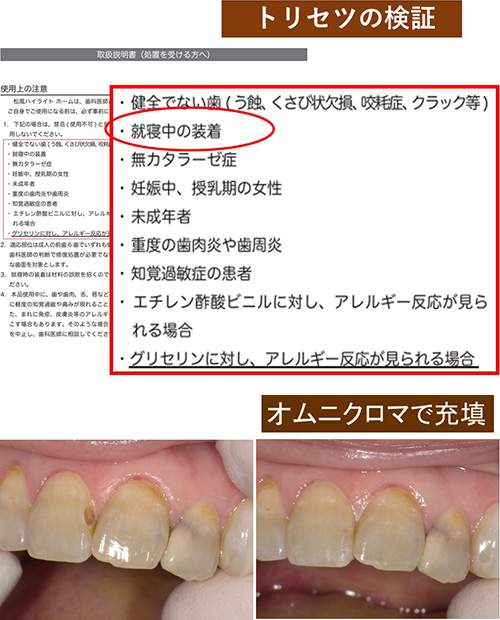 たとえ修復歯があっても、ホワイトニングは推奨されます