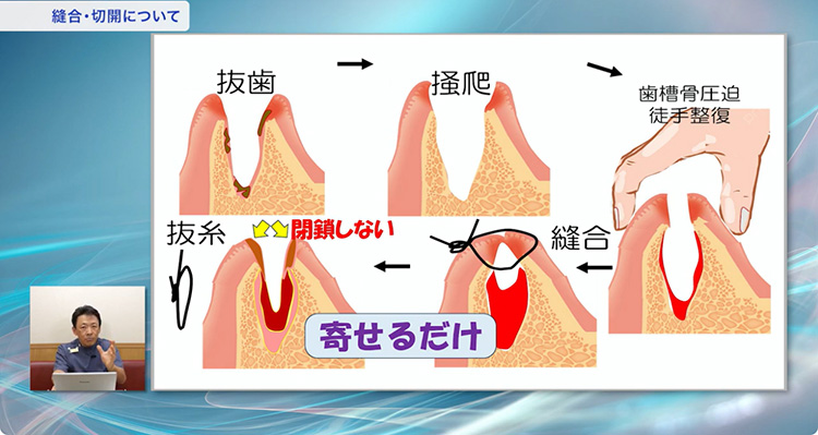 これを知れば、縫合の考え方が180度変わるはずです