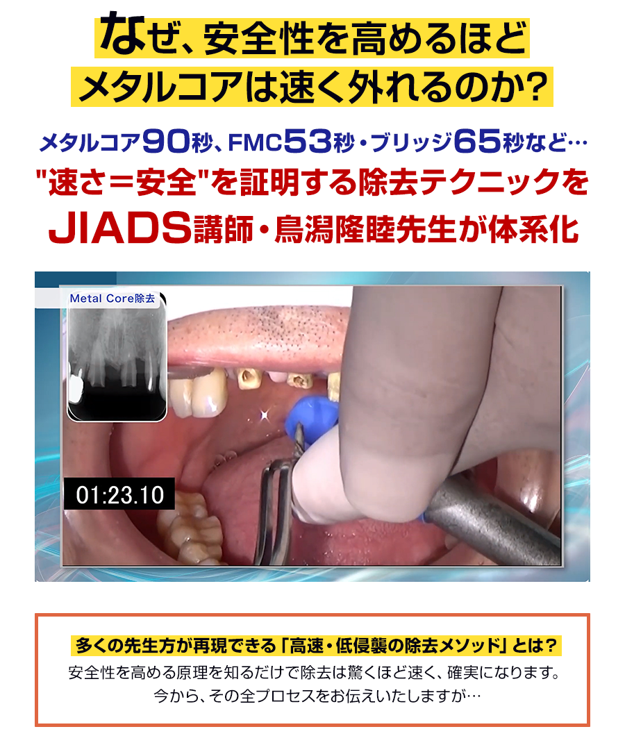なぜ、安全性を高めるほどメタルコアは速く外れるのか？メタルコア90秒、FMC53秒・ブリッジ65秒など…「速さ＝安全」を証明する除去テクニックをJIADS講師・鳥潟隆睦先生が体系化