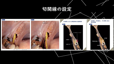 低侵襲と安全を両立する手技を、順序立てて学べます