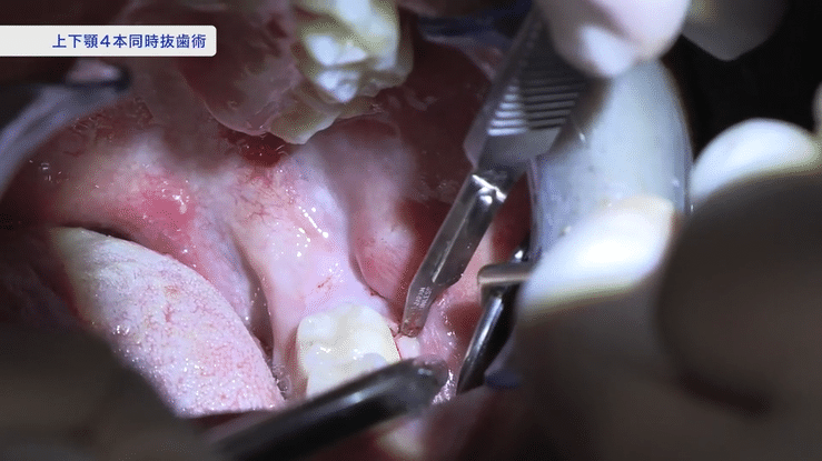 低侵襲と安全を両立する手技を、順序立てて学べます