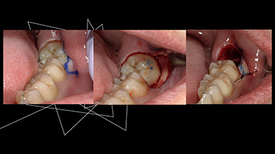 低侵襲と安全を両立する手技を、順序立てて学べます