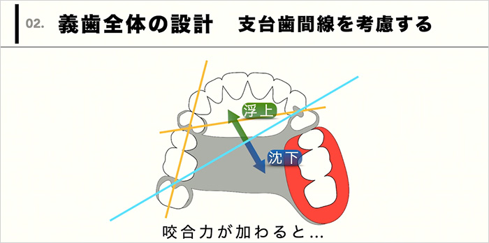 さまざまな欠損パターンに応用できる技術が身につきます