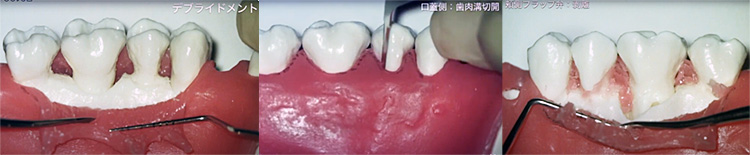 歯間乳頭部および歯肉溝切開、頬側フラップ弁の剥離、歯間乳頭部の切離、舌側フラップ弁の剥離、デブライドメント、再生材料充填、縫合などの実習映像を収録